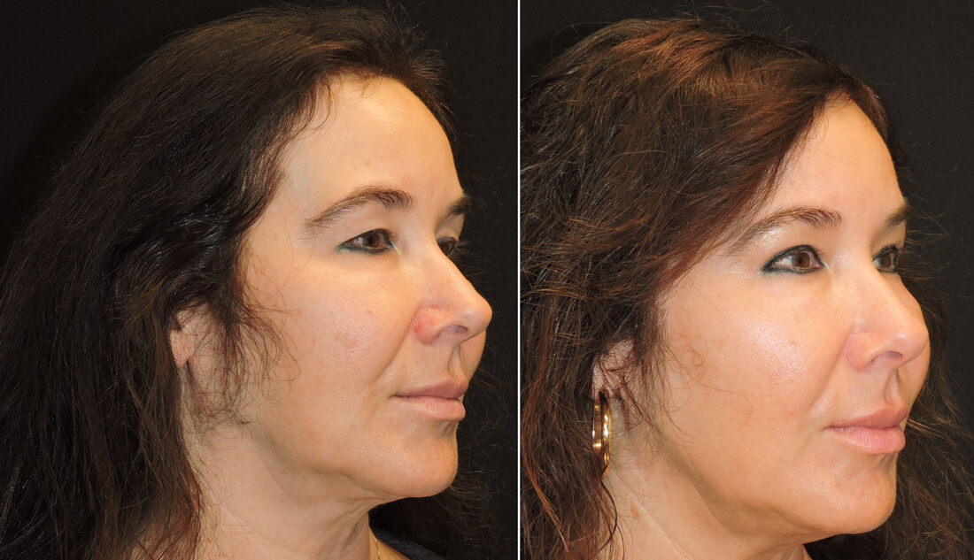 eyelids patient face