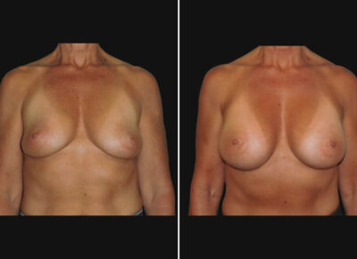 Breast Augmentation – Dr. Zeiderman