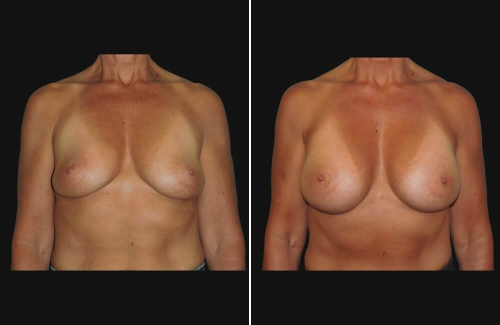 front breast augmentation patient before and after