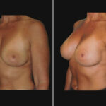 Thumbnail of http://side%20breast%20augmentation%20patient%20before%20and%20after