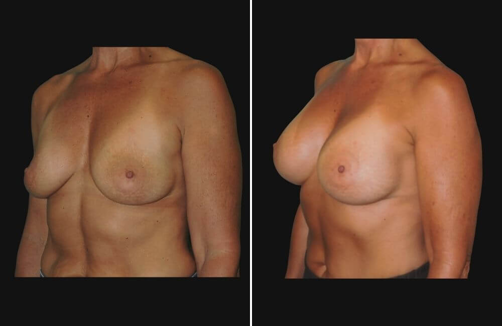 side breast augmentation patient before and after