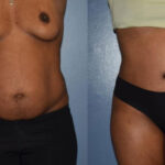 Thumbnail of http://Dr%20Curtis%20Abdominoplasty%20Surgery%20before%20and%20after