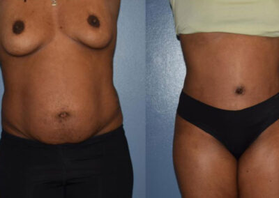 Abdominoplasty Patient 1
