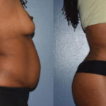 Thumbnail of http://Dr%20Curtis%20Abdominoplasty%20Surgery%20before%20and%20after%20side%20view