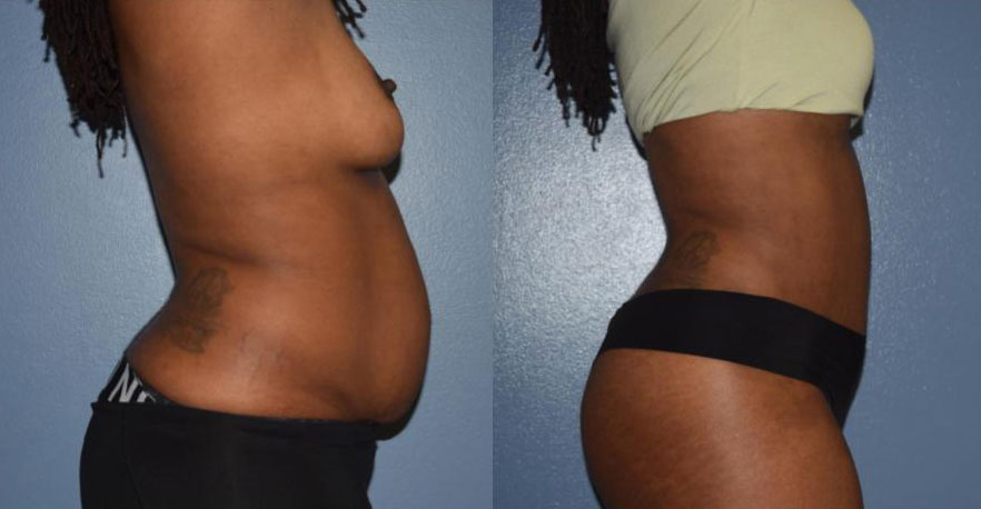 Dr Curtis Abdominoplasty Surgery before and after side view