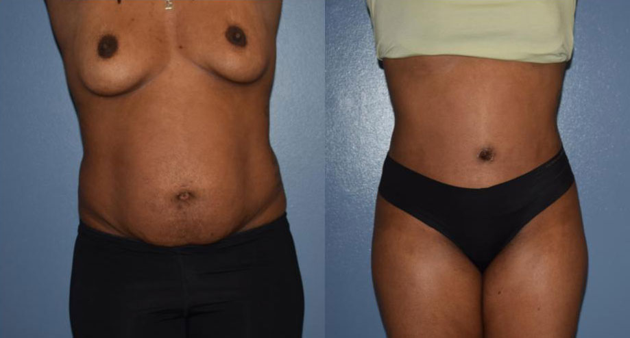 Dr Curtis Abdominoplasty Surgery before and after
