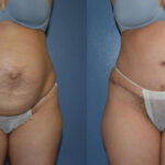 Thumbnail of http://Dr%20Curtis%20Abdominoplasty%20Surgery%20before%20and%20after