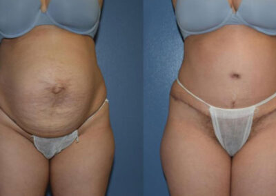 Abdominoplasty Patient 2