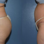 Thumbnail of http://Dr%20Curtis%20Abdominoplasty%20Surgery%20before%20and%20after%20side%20view