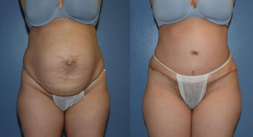 Dr Curtis Abdominoplasty Surgery before and after