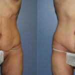 Thumbnail of http://Dr%20Curtis%20Abdominoplasty%20Surgery%20before%20and%20after