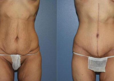 Abdominoplasty Patient 3