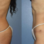 Thumbnail of http://Dr%20Curtis%20Abdominoplasty%20Surgery%20before%20and%20after%20side%20view