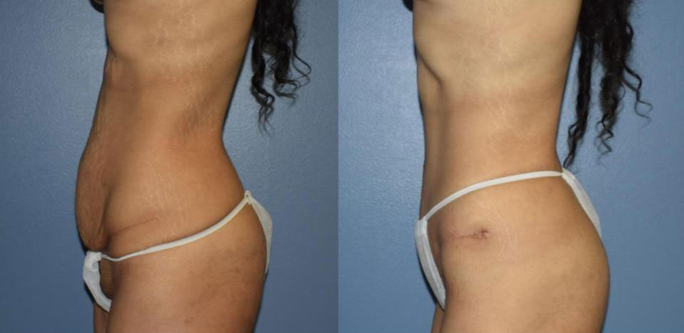 Dr Curtis Abdominoplasty Surgery before and after side view