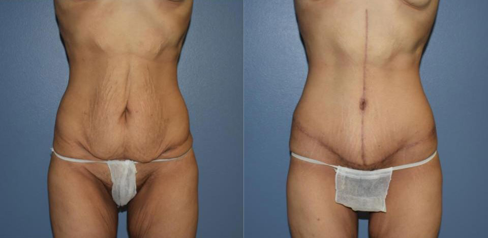 Dr Curtis Abdominoplasty Surgery before and after