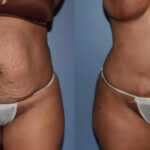 Thumbnail of http://Dr%20Curtis%20Abdominoplasty%20Surgery%20before%20and%20after