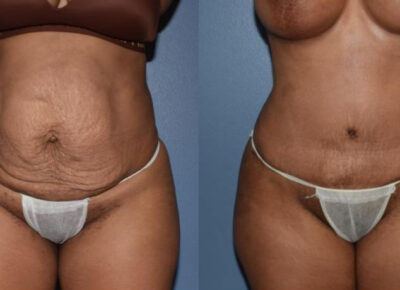 Abdominoplasty Patient 4