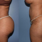 Thumbnail of http://Dr%20Curtis%20Abdominoplasty%20Surgery%20before%20and%20after%20side%20view
