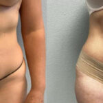Thumbnail of http://Dr%20Curtis%20Abdominoplasty%20Surgery%20before%20and%20after