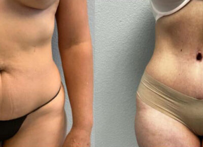 Abdominoplasty Patient 5