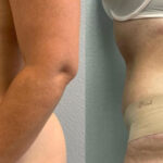 Thumbnail of http://Dr%20Curtis%20Abdominoplasty%20Surgery%20before%20and%20after%20side%20view