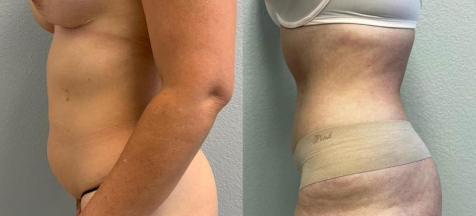 Dr Curtis Abdominoplasty Surgery before and after side view