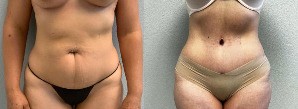 Dr Curtis Abdominoplasty Surgery before and after