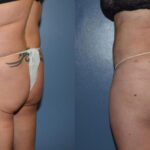 Thumbnail of http://Dr%20Curtis%20Brazilian%20Butt%20Lift%20before%20and%20after
