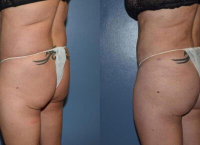 Brazilian Butt Lift Patient 1