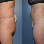 Thumbnail of http://Dr%20Curtis%20Brazilian%20Butt%20Lift%20before%20and%20after