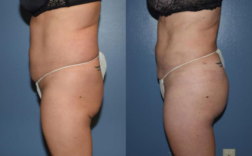 Dr Curtis Brazilian Butt Lift before and after