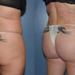 Thumbnail of http://Dr%20Curtis%20Brazilian%20Butt%20Lift%20before%20and%20after