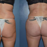 Thumbnail of http://Dr%20Curtis%20Brazilian%20Butt%20Lift%20before%20and%20after