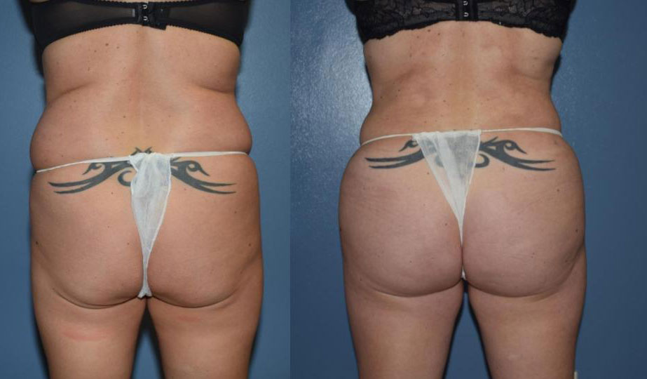 Dr Curtis Brazilian Butt Lift before and after