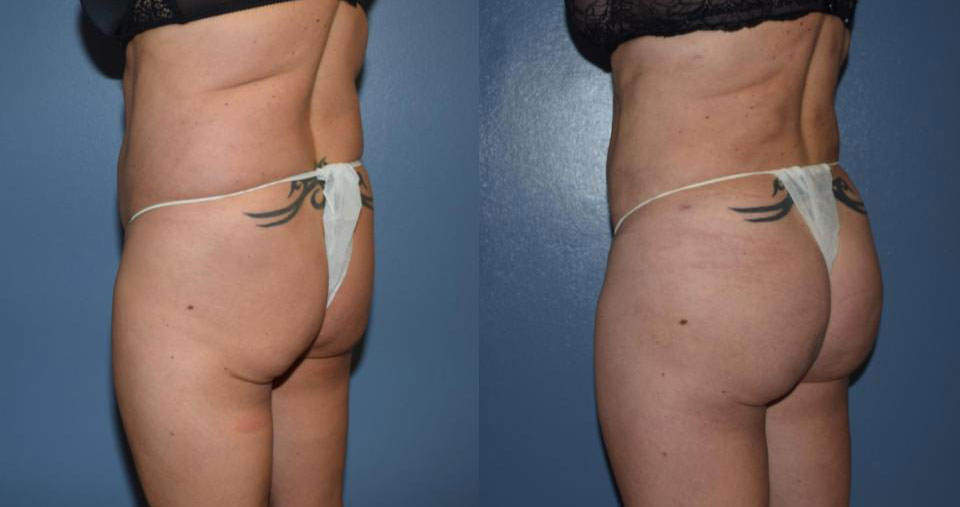 Dr Curtis Brazilian Butt Lift before and after