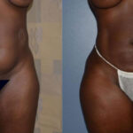 Thumbnail of http://Dr%20Curtis%20Brazilian%20Butt%20Lift%20before%20and%20after