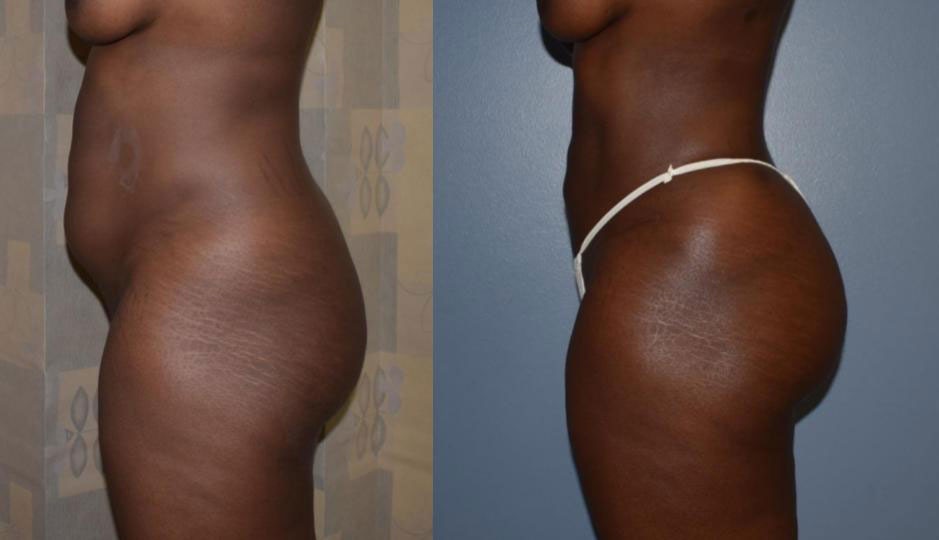 Dr Curtis Brazilian Butt Lift before and after