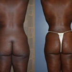 Thumbnail of http://Dr%20Curtis%20Brazilian%20Butt%20Lift%20before%20and%20after