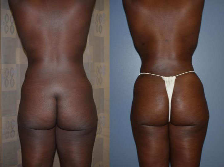 Dr Curtis Brazilian Butt Lift before and after