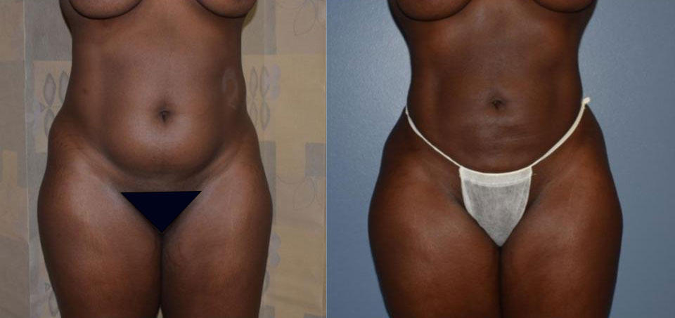 Dr Curtis Brazilian Butt Lift before and after