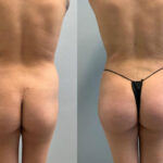 Thumbnail of http://Dr%20Curtis%20Brazilian%20Butt%20Lift%20before%20and%20after