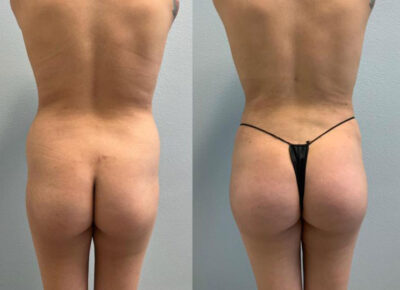 Brazilian Butt Lift Patient 3
