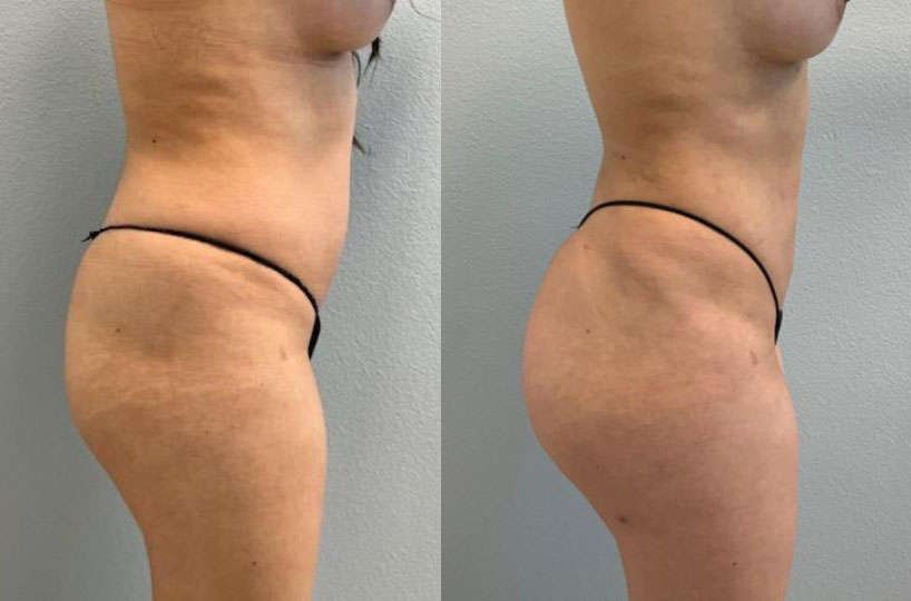 Dr Curtis Brazilian Butt Lift before and after
