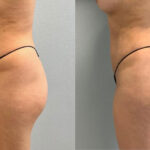 Thumbnail of http://Dr%20Curtis%20Brazilian%20Butt%20Lift%20before%20and%20after