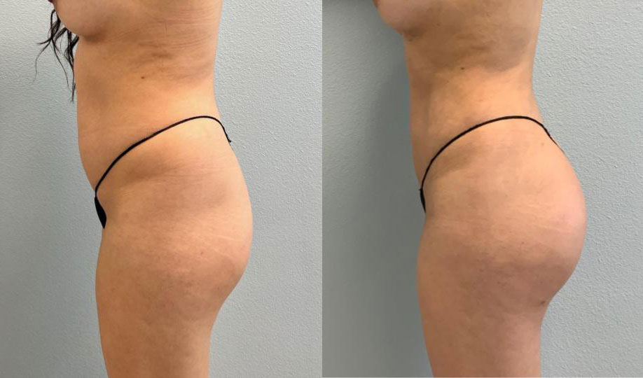 Dr Curtis Brazilian Butt Lift before and after