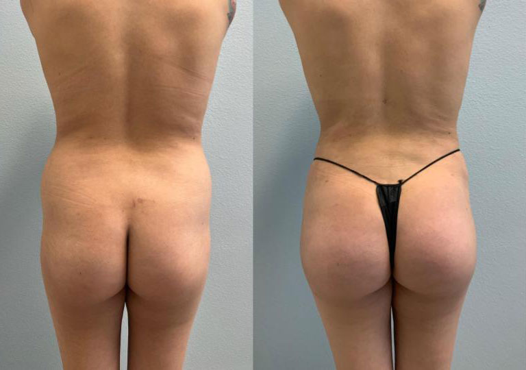 Dr Curtis Brazilian Butt Lift before and after