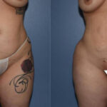 Thumbnail of http://Dr%20Curtis%20Brazilian%20Butt%20Lift%20before%20and%20after