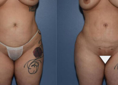 Brazilian Butt Lift Patient 4