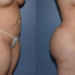 Thumbnail of http://Dr%20Curtis%20Brazilian%20Butt%20Lift%20before%20and%20after