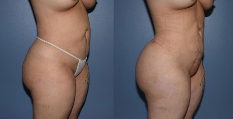 Dr Curtis Brazilian Butt Lift before and after
